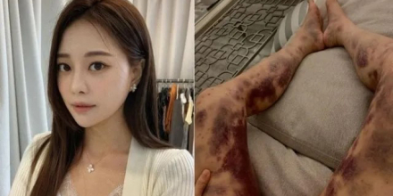 아옳이, ‘온몸에 피멍’ 주장... 13억 소송 승소